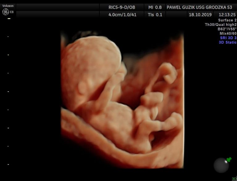 Bezpłatne badania USG 3D ciąży