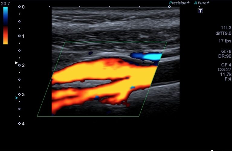 USG dopplerowskie tętnic szyjnych – zostały ostatnie miejsca